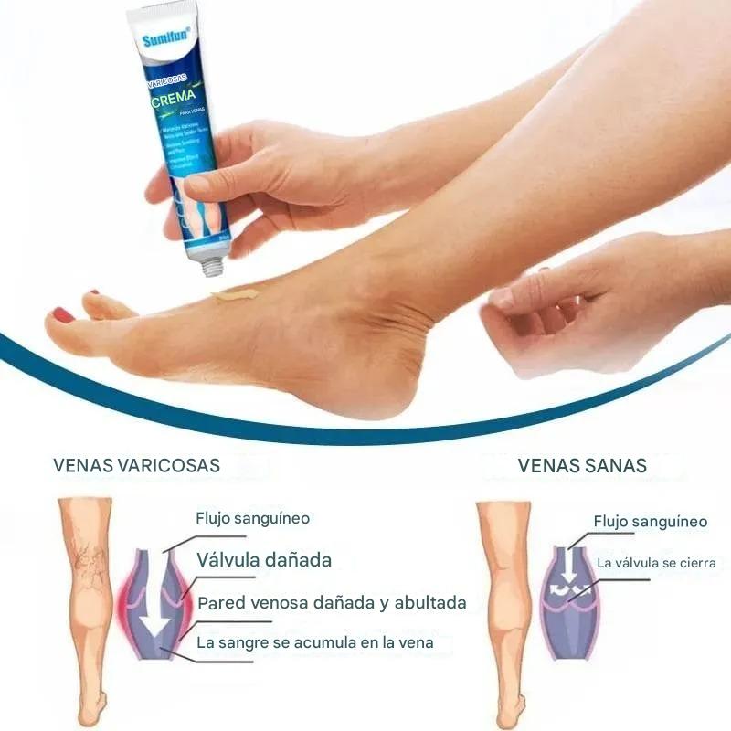 💙Crema para mejorar la circulación y desaparecer varices